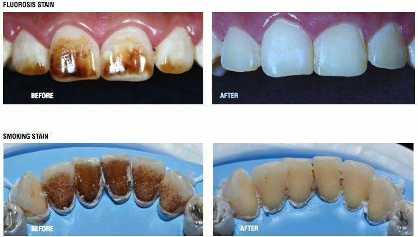 MDC Antivet Kit For Fluorosis & Smoking Stain Removal